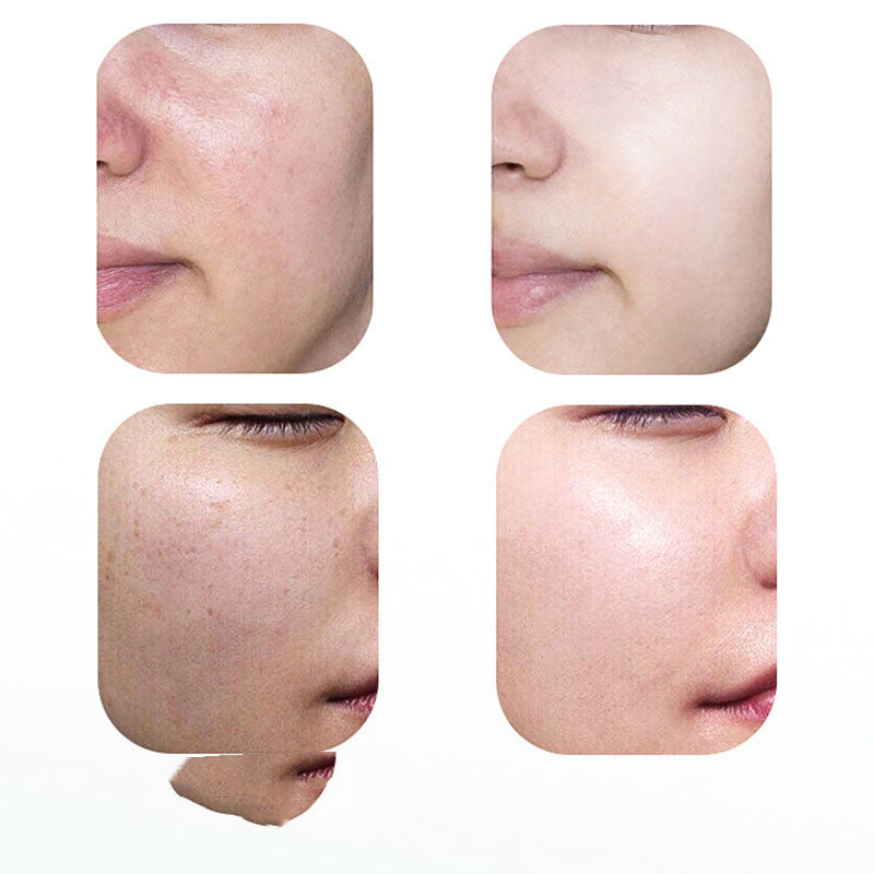 Face Beauty Photon Skin Rejuvenation Device